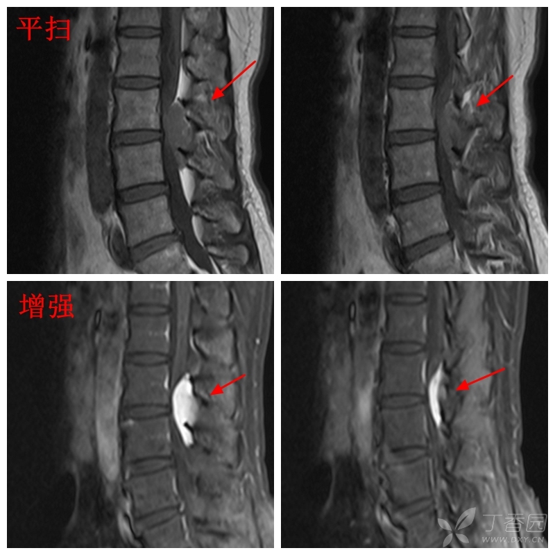 t2抑脂序列呈高信号,大小约18mm×18mm×46mm,相应硬膜囊受压向前移位