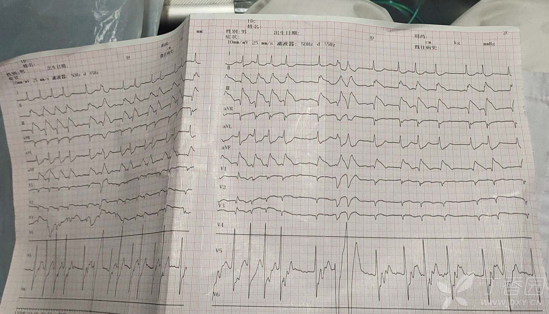 【求助】心电图判读