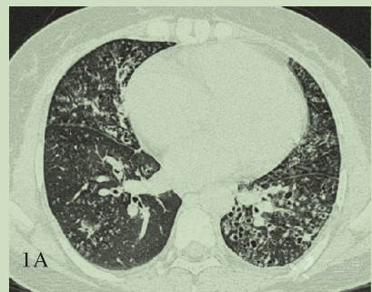 弥漫性泛细支气管炎:双肺弥漫小结节,请想起小姐姐我
