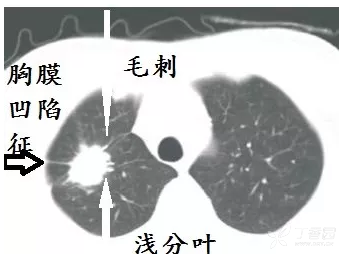 肺门肿块,肿块侵入支气管,鳞癌.假如出现阻塞性肺炎,更支持鳞癌.
