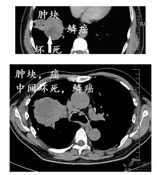 乱七八糟的空洞,肿瘤内液化坏死,等等,大部分是鳞癌!