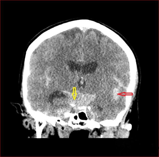 平扫 ct,可见广泛的蛛网膜下腔出血,累及基底池(黄色箭头,外侧