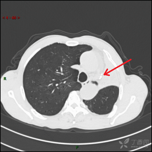 >> 不再显示 × 患者行支气管镜检查后,间隔4天复查pet-ct发现左肺门