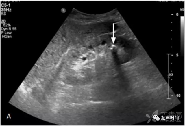急性腰痛的超声检查肾结石和急性肾盂肾炎
