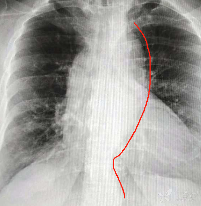 胸片诊断要小心,千万不可太粗心(病理已公布)