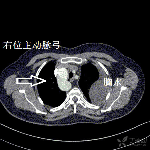 奇怪病例:右位主动脉弓变异.