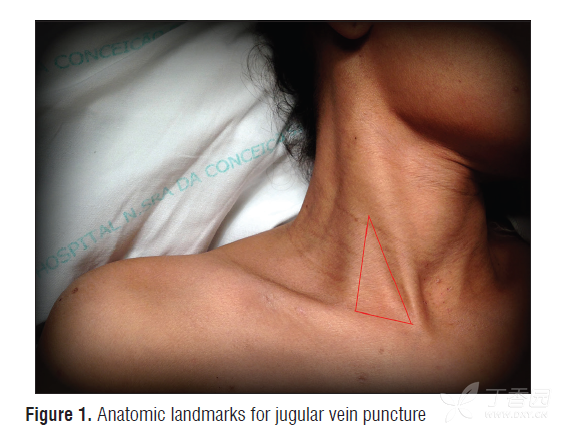 穿刺点(中路):胸锁乳突肌的胸骨头,锁骨头与锁骨上缘构成颈动脉三角