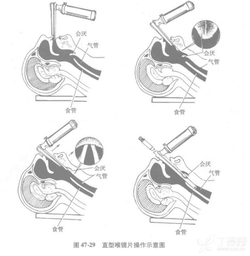 和纤维支气管镜检査可见气管环及隆突是判断导管位于气管内的可靠指标