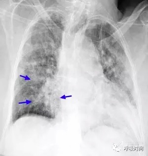 6 肺渗出性病变影——肺下叶支气管肺炎