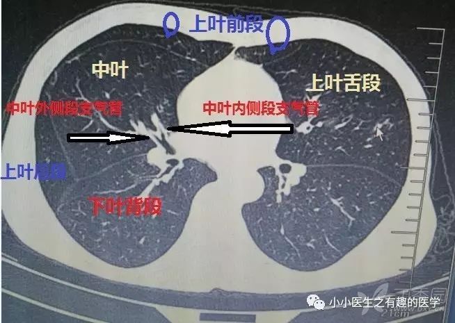 并且右肺中叶支气管出现后,再往下,右肺下叶背段就逐渐
