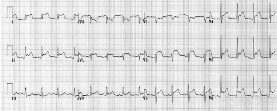 不是所有的心电图有抬高都是心肌梗死,对于心电图可见广泛st段抬高
