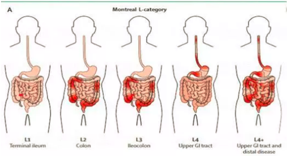 这些炎症性肠病的消化道表现,你都知道吗?