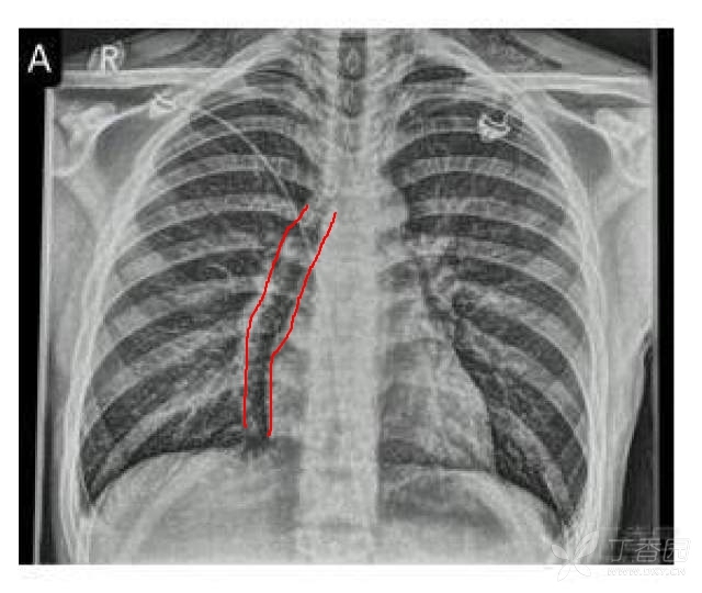 胸片肺纹理正常,未见气胸,心脏周围可见气体影,考虑纵膈气肿.