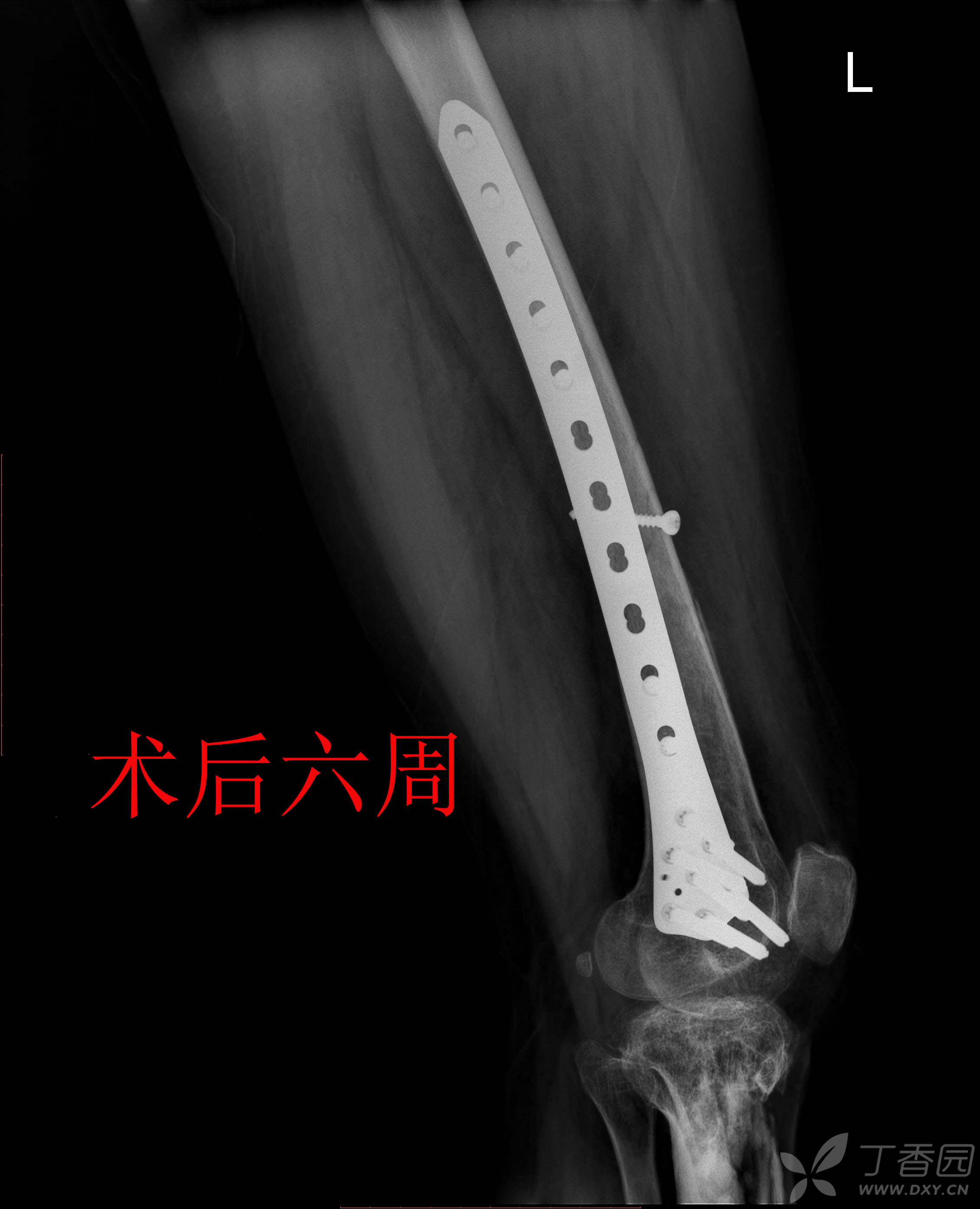 股骨远端骨折锁定钢板固定术后14月骨不连,影像资料清晰,连贯,请老师