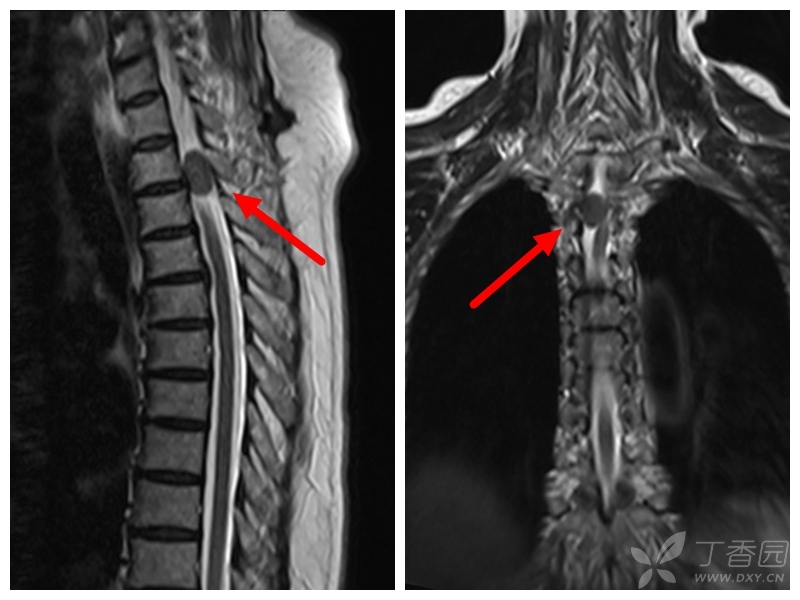 椎管内占位,有病理,无增强,欢迎来秒!