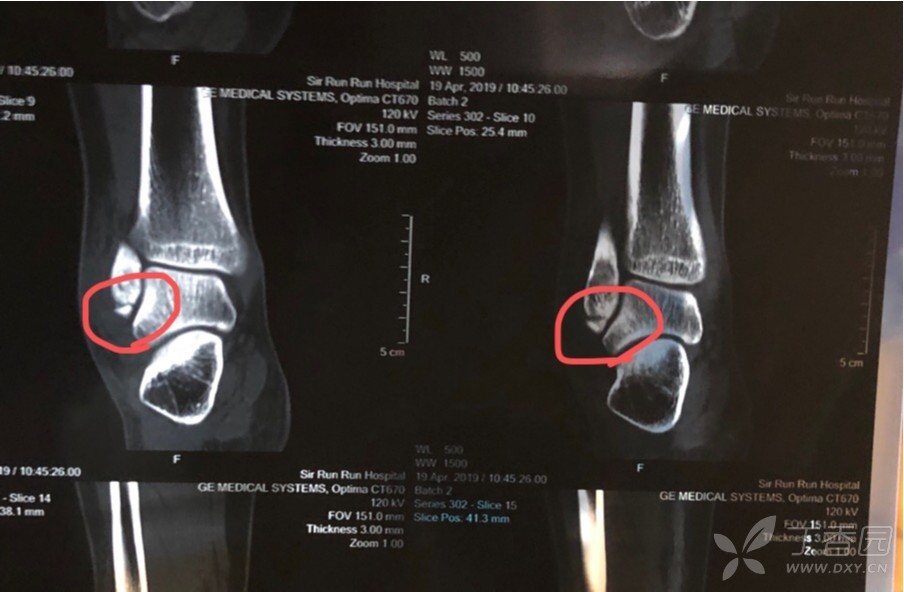 次日就诊,右脚外踝腓骨撕脱性骨折.医生建议