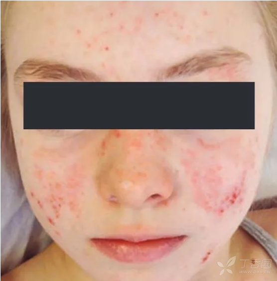光化性痒疹:一例 岁女童面中央红斑基础上的红丘疹,抓痕和结痂