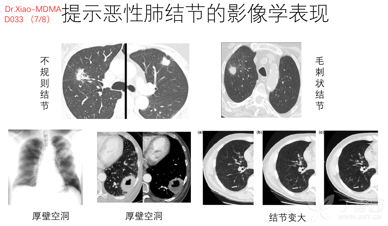 提示恶性肺结节的影像学表现
