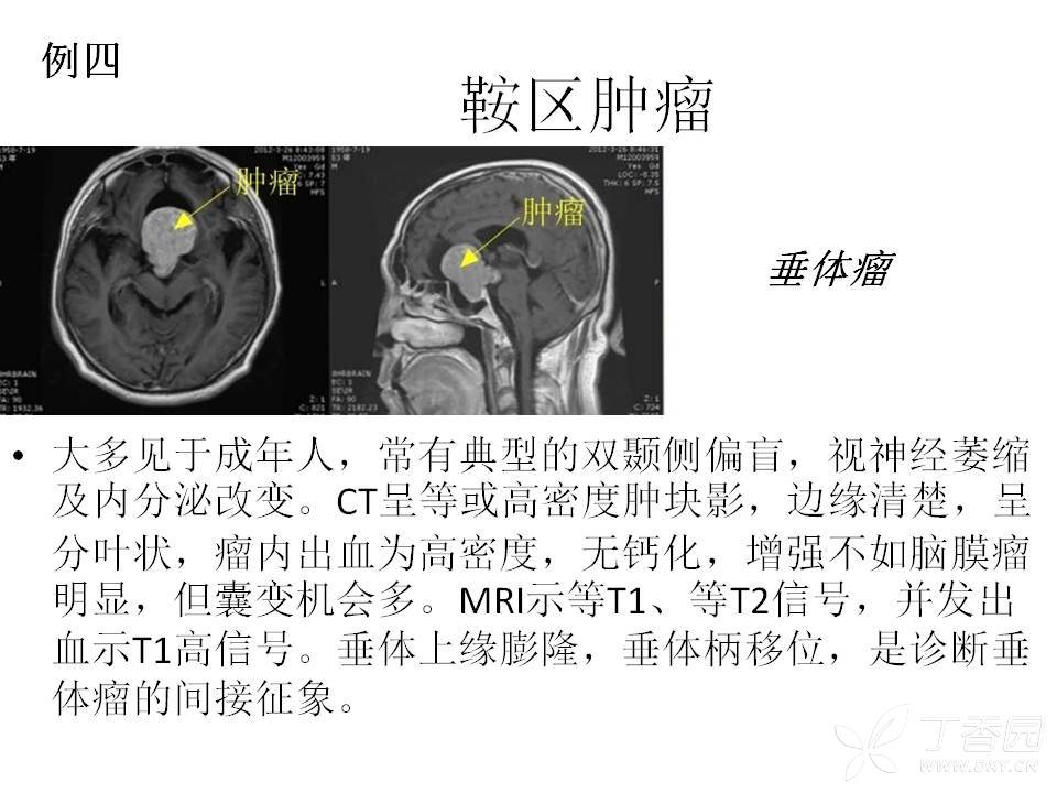 颅神经解剖之-视神经