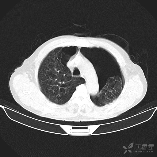 气胸or肺大疱? - 影像医学和核医学讨论版 -丁香园论坛