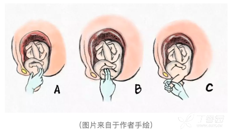 遭遇肩难产 这6种方法保你顺利过关