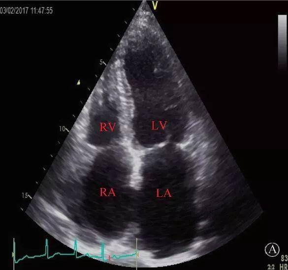 a:心尖四腔心切面示双房左室大为主