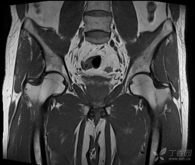 髋关节剧痛   mri 提示骨髓水肿   半年内完全自愈