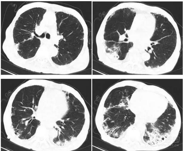 1-4 aecopd 并间质性肺炎,双下肺炎表现