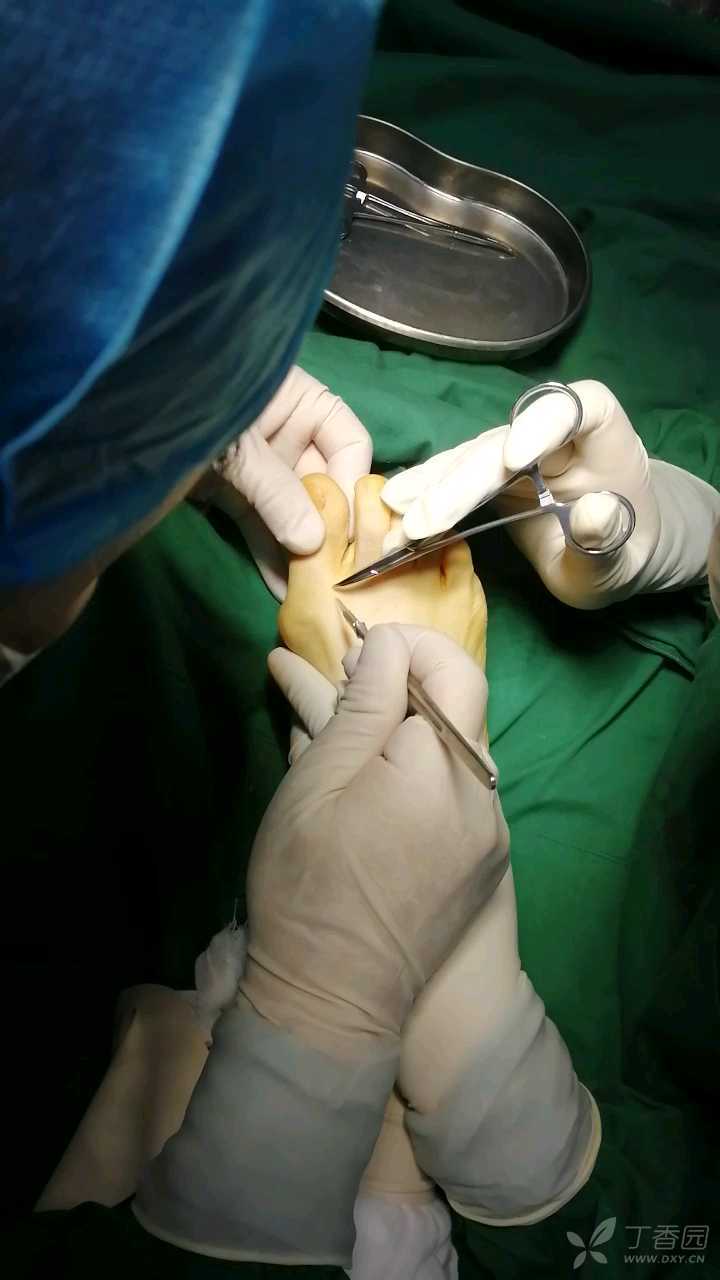 手术视频:拇外翻病例,手术过程记录