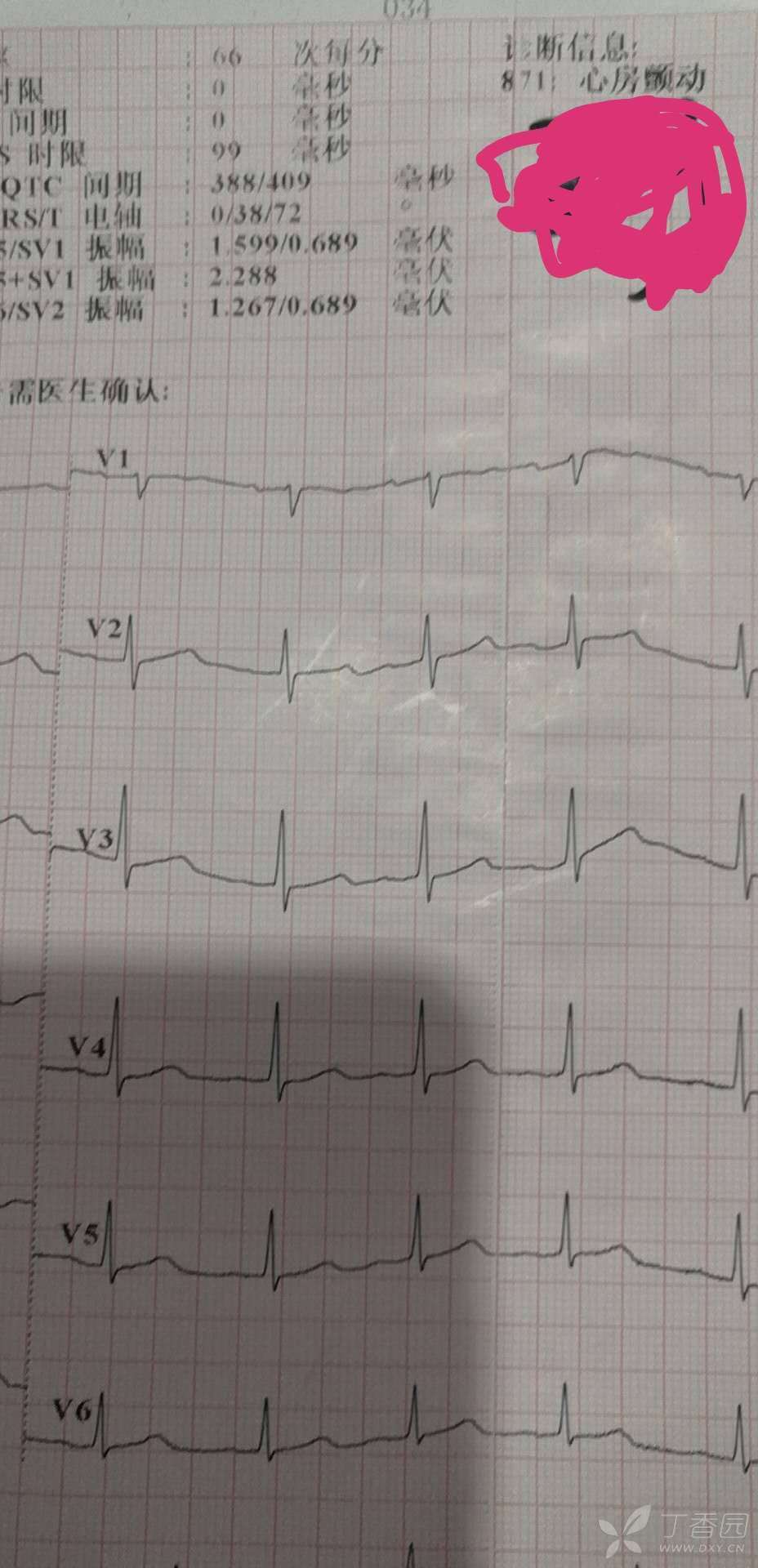 请高手分析一个心肌梗死的心电图和心梗标志物演变(确诊心梗) [病例帖