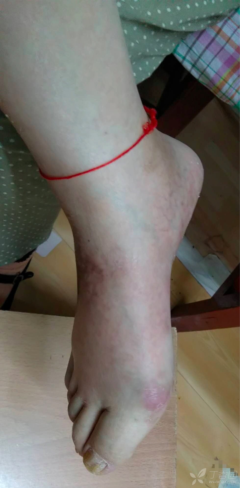 求助:患者脚部扭伤,脚部浮肿,应该如何处理(图片)?