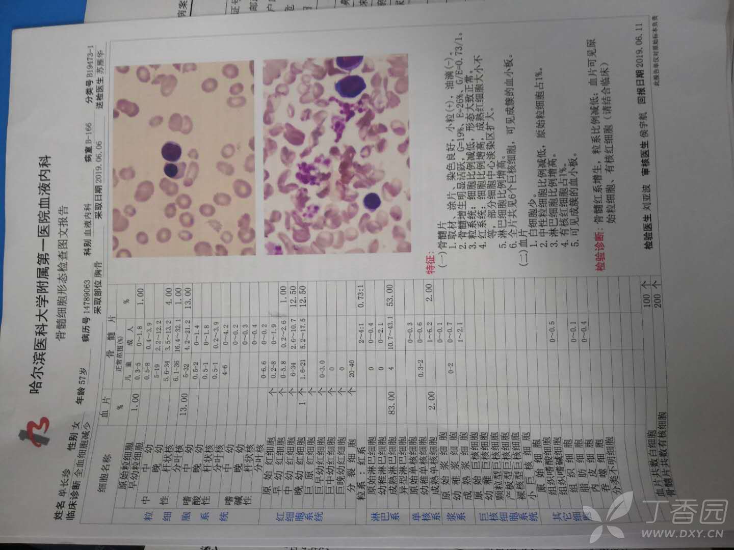 骨髓增生异常综合征 ,有了解这个的么,求解释,根据报告看,严重么,谢谢