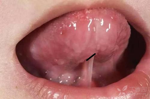舌系带断裂,说话没影响,能自行愈合还是需要缝合?