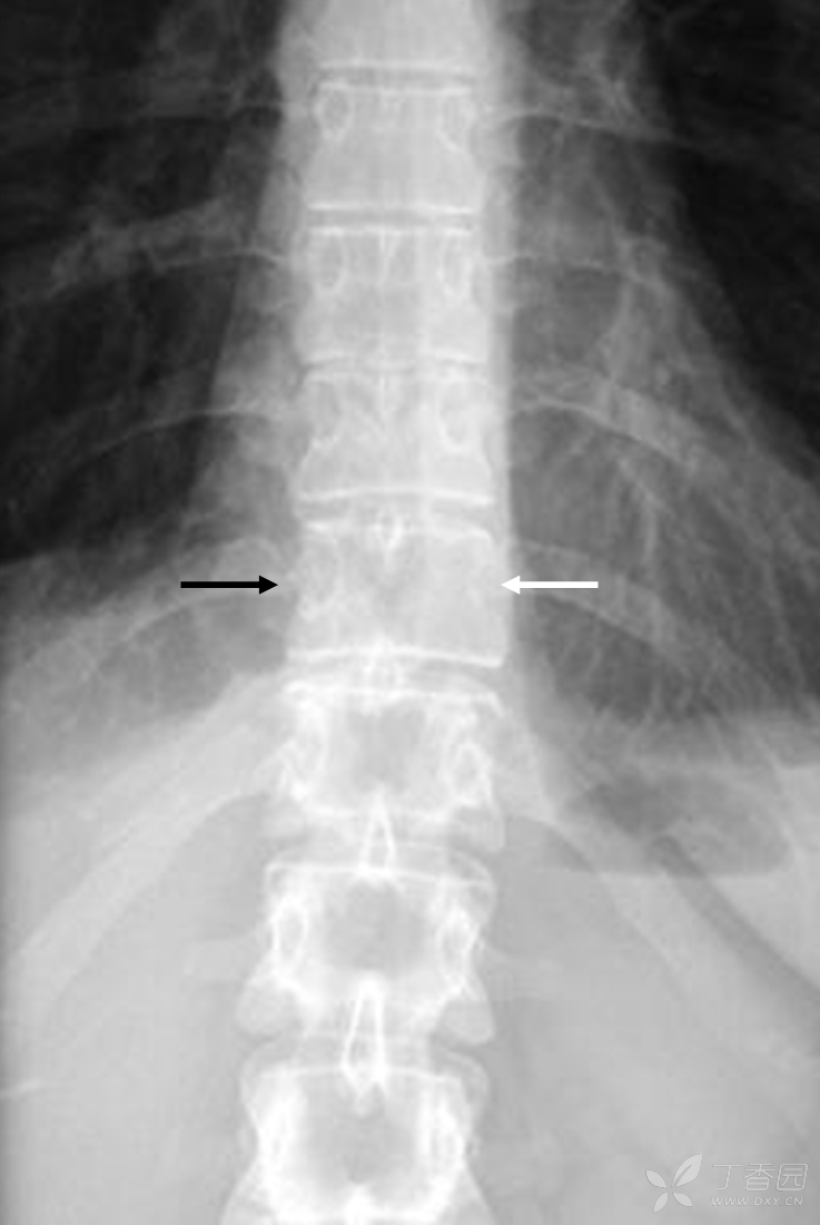 腰椎正位片,示第3腰椎右侧椎gong环影破坏消失.