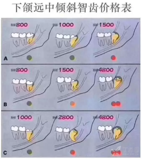 有一些正位的智齿,它的拔牙过程也比较轻松,手术也比较简单,它的费用