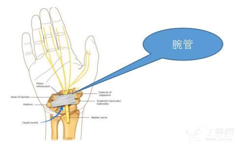 手麻未必就是颈椎病,还有可能是腕管综合症