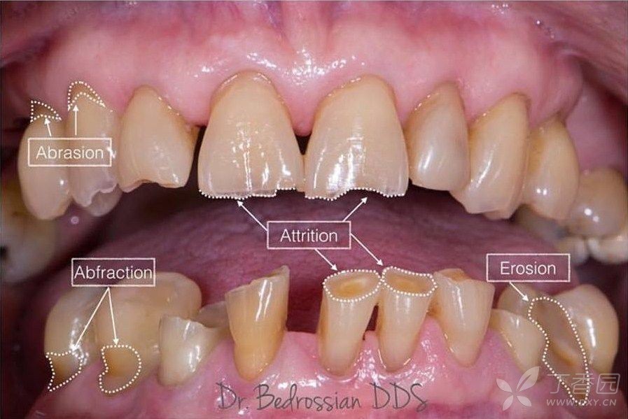 牙齿的磨耗随着年龄增长而逐渐明显,医学教育|网搜集整理多发生在牙齿