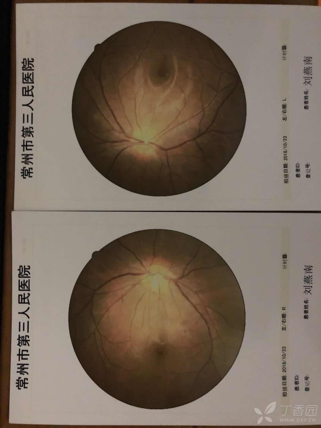 复视 肌肉颤动(脸,全身)
