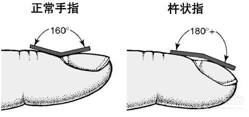怎样才算是杵状指?具体以哪个位置来算?让精典图文来告诉你!