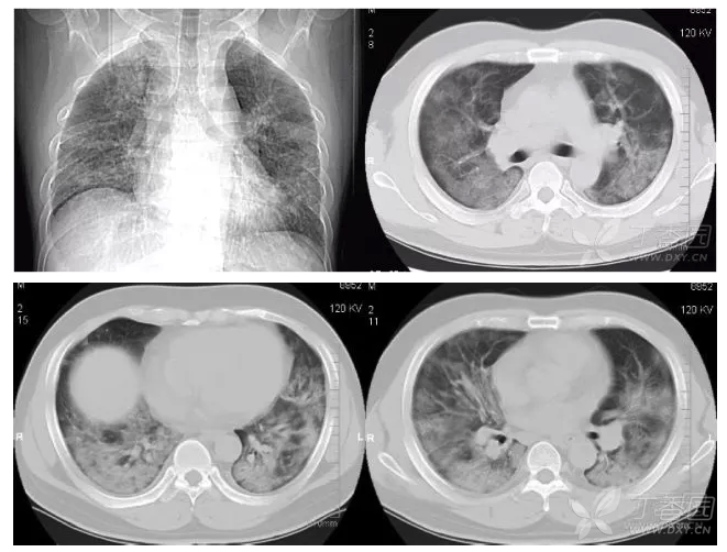 2 h1n1 肺炎:ct 显示双肺片絮状,磨玻璃样影呈弥漫性分布.