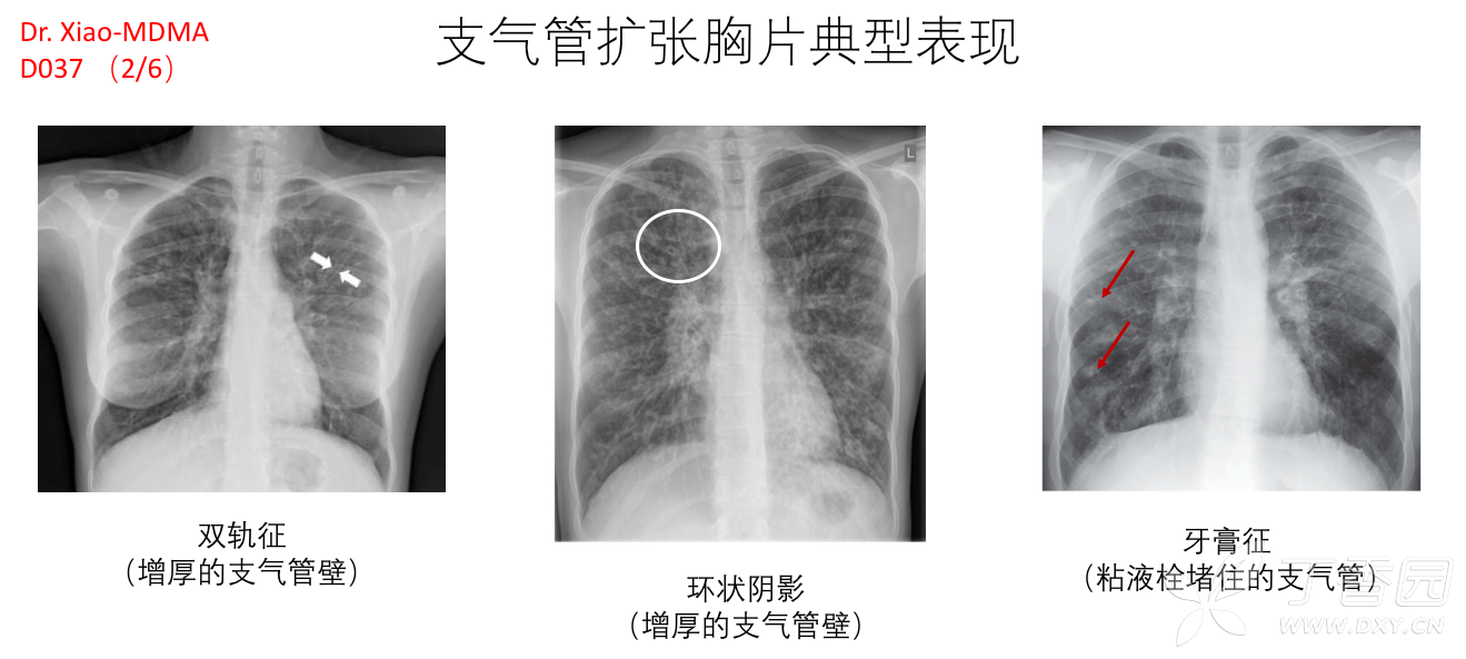 支气管扩张临床决策思维导图(dr xiao-mdma之d037)