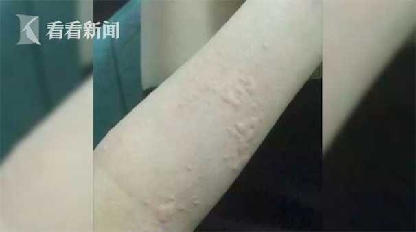 准妈妈吃下20只小龙虾,致荨麻疹险失胎儿.