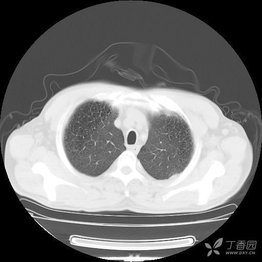 1楼的片子典型的桶状胸,爽肺野密度减低,似乎是肺气肿晚起的表现