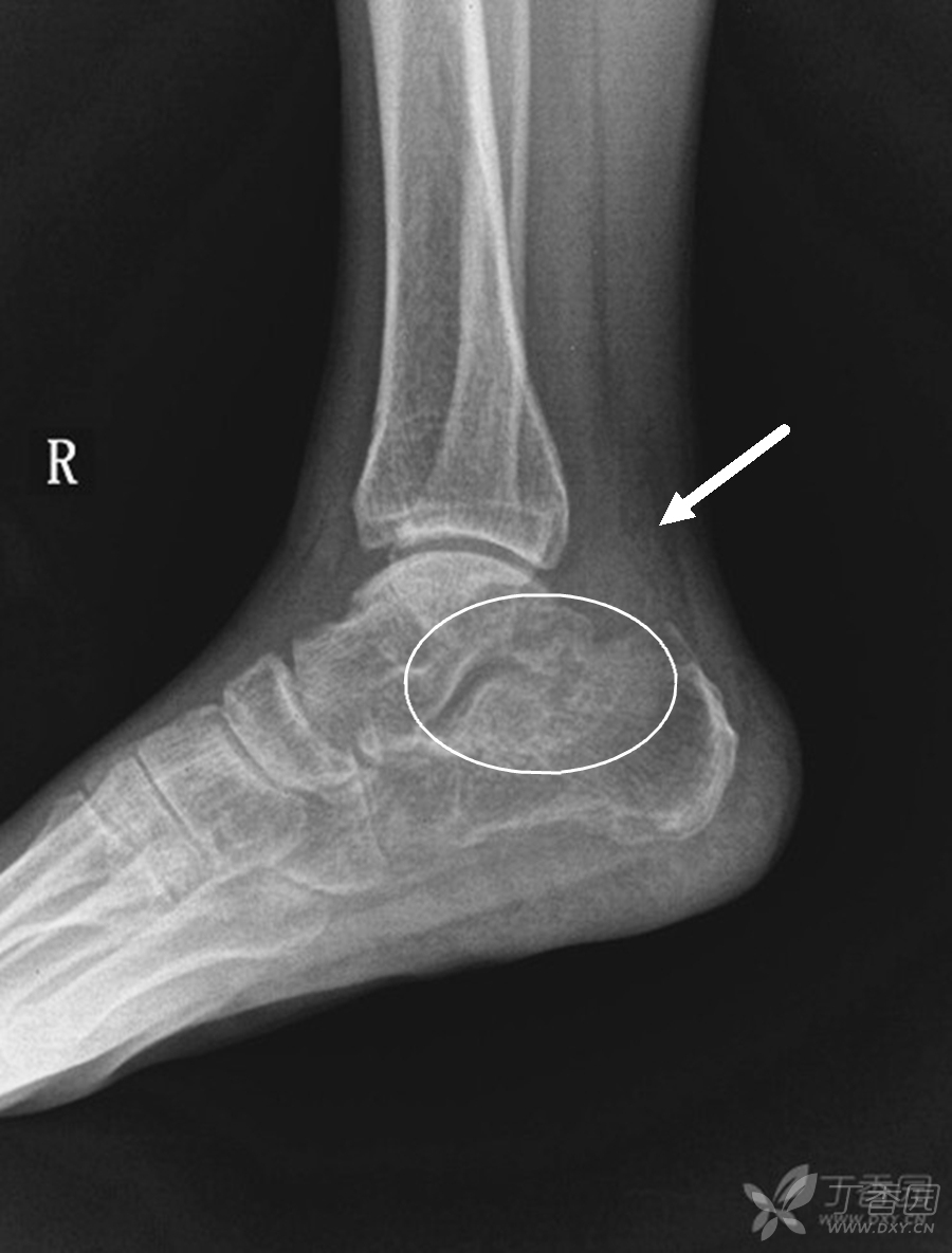 典型病例欣赏"第六期" 没有病史的踝关节.(结果已公布) [病例帖]