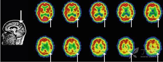 痴呆神经影像改变一 皮质萎缩之 阿尔茨海默病ad