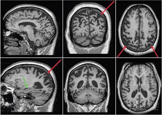 痴呆神经影像改变一 皮质萎缩之 阿尔茨海默病ad