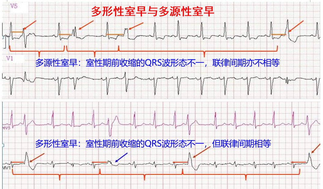 同一导联出现不等的联律间期称为多源性,代表不同的心室兴奋起源点