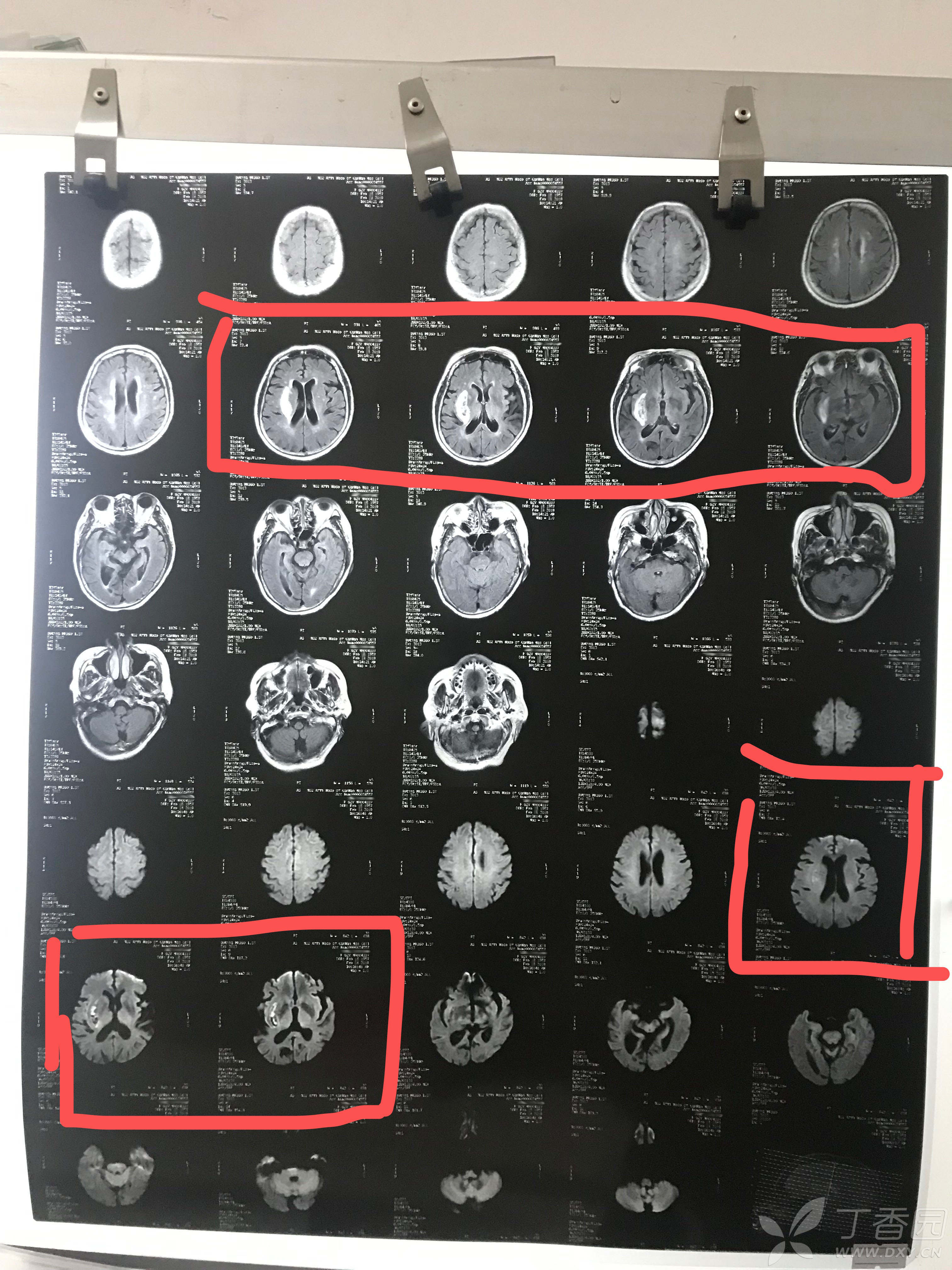 头部核磁共振mri一张,能看出什么问题来?