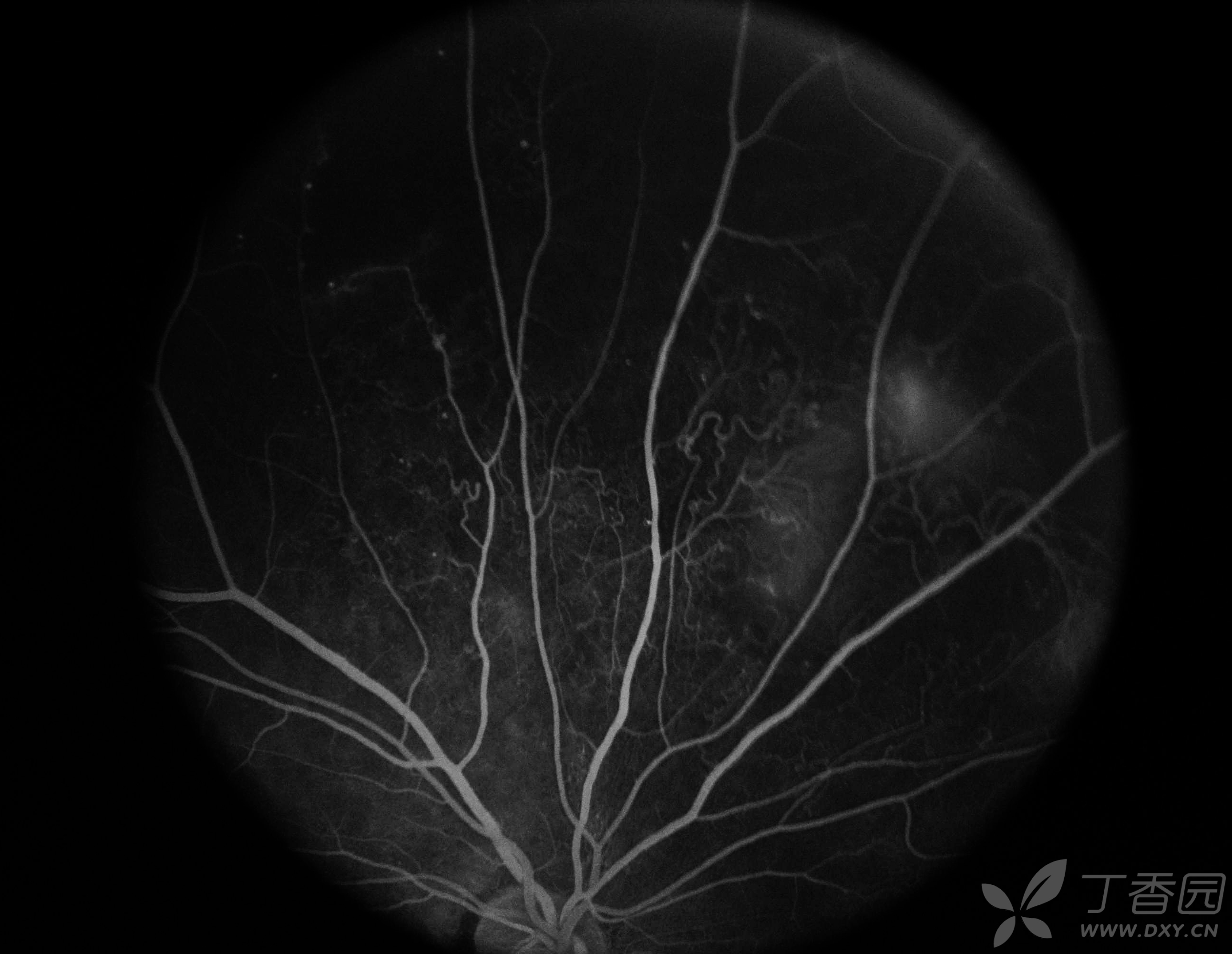 一例特殊的眼底病变,你会做出什么诊断呢?