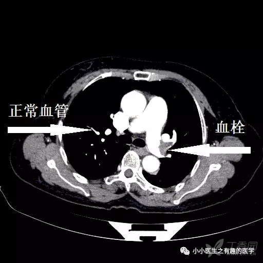 左肺动脉血栓